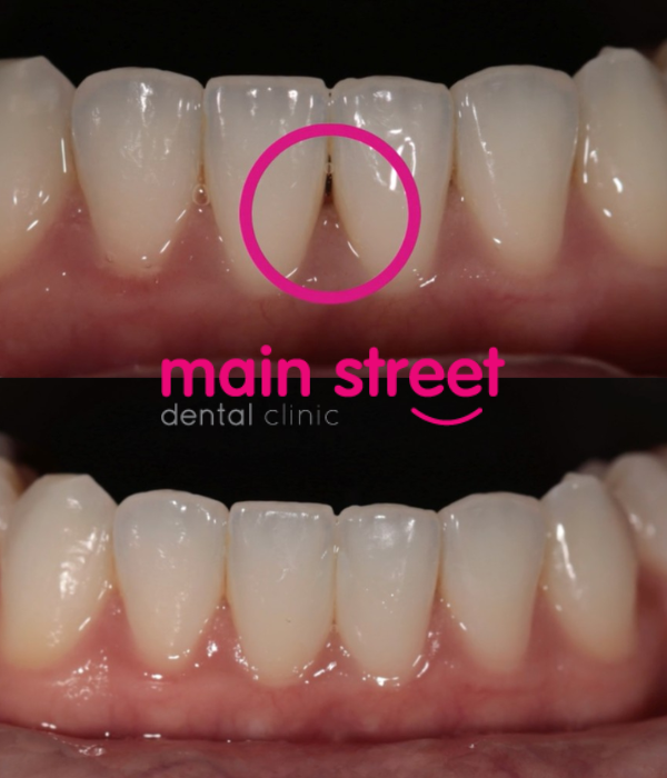 composite bonding – subtle closure – before and after