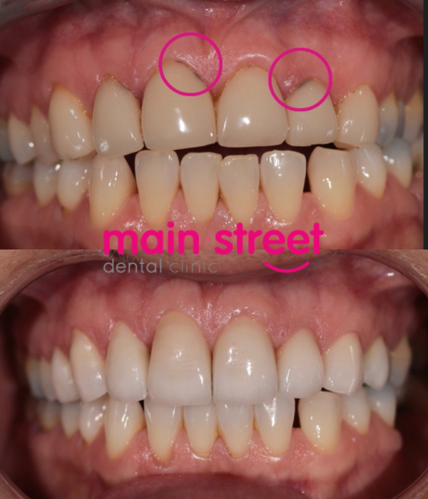 dental crown replacement – before and after