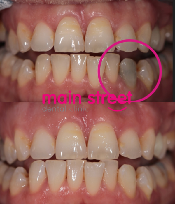 single dark tooth whitening – before and after