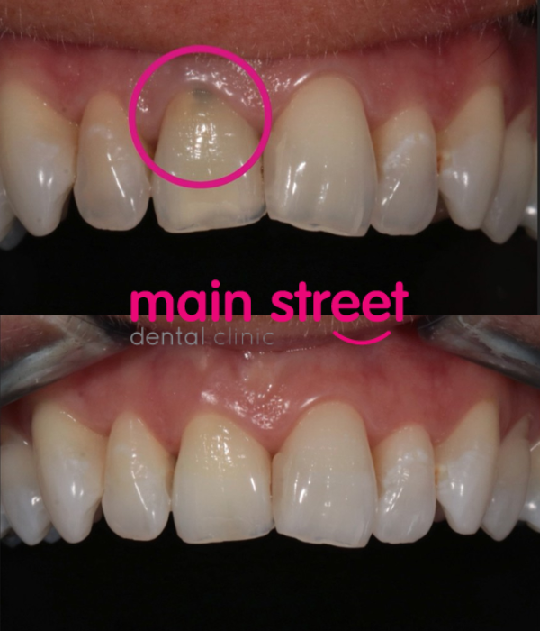 single tooth whitening 2 – before and after
