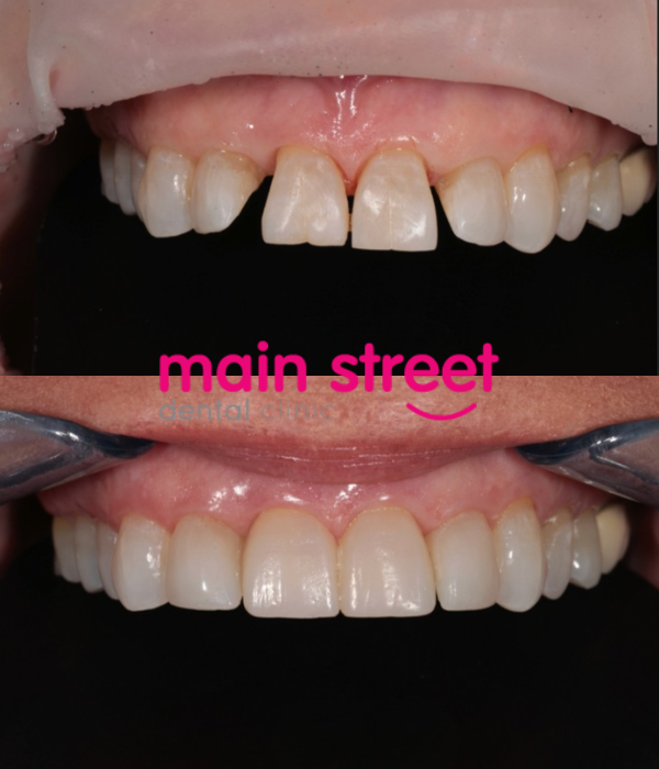 smile design composite bonding – before and after
