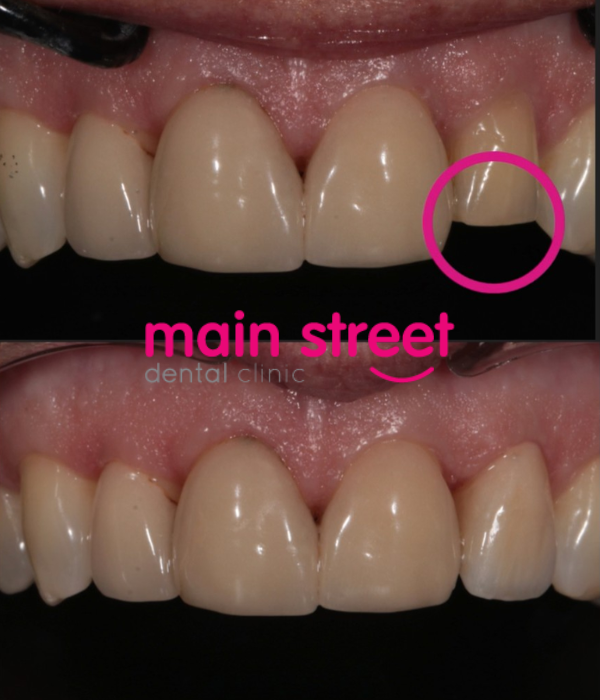veneer – replace broken tooth – before and after